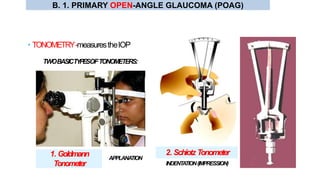 • TONOMETRY-measurestheIOP
TWOBASICTYPESOFTONOMETERS:
INDENTATION(IMPRESSION)
2. Schiotz Tonometer
APPLANATION
1. Goldmann
Tonometer
B. 1. PRIMARY OPEN-ANGLE GLAUCOMA (POAG)
 