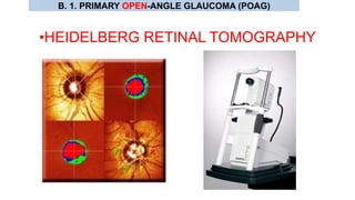 •HEIDELBERG RETINAL TOMOGRAPHY
B. 1. PRIMARY OPEN-ANGLE GLAUCOMA (POAG)
 