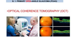 •OPTICAL COHERENCE TOMOGRAPHY (OCT)
B. 1. PRIMARY OPEN-ANGLE GLAUCOMA (POAG)
 