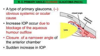 B. 2. PRIMARY ANGLE-CLOSURE GLAUCOMA (PACG)
• A type of primary glaucoma, (–)
obvious systemic or ocular
cause
• Increase IOP occur due to
blockage of the aqueous
humour outflow
• Closure of a narrower angle of
the anterior chamber
• Sudden increase in IOP
 