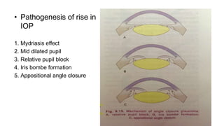 • Pathogenesis of rise in
IOP
1. Mydriasis effect
2. Mid dilated pupil
3. Relative pupil block
4. Iris bombe formation
5. Appositional angle closure
 