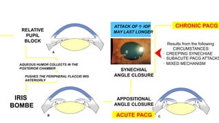 RELATIVE
PUPIL
BLOCK
AQUEOUS HUMOR COLLECTS IN THE
POSTERIOR CHAMBER
PUSHES THE PERIPHERAL FLACCID IRIS
ANTERIORLY
IRIS
BOMBE
APPOSITIONAL
ANGLE CLOSURE
SYNECHIAL
ANGLE CLOSURE
ATTACK OF  IOP
MAY LAST LONGER
ACUTE PACG
CHRONIC PACG
Results from the following
CIRCUMSTANCES:
• CREEPING SYNECHIAE
• SUBACUTE PACG ATTACKS
• MIXED MECHANISM
 