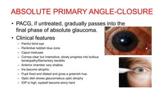 ABSOLUTE PRIMARY ANGLE-CLOSURE
• PACG, if untreated, gradually passes into the
final phase of absolute glaucoma.
• Clinical features
– Painful blind eye
– Perilimbal reddish blue zone
– Caput medusae
– Cornea clear but insensitive; slowly progress into bullous
keratopathy/filamentary keratitis
– Anterior chamber very shallow
– Iris become atrophic
– Pupil fixed and dilated and gives a greenish hue.
– Optic dish shows glaucomatous optic atrophy
– IOP is high, eyeball become stony hard
 