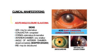 CLINICAL MANIFESTATIONS:
ACUTEANGLE-CLOSUREGLAUCOMA
SIGNS
• LIDS-may be edematous
• CONJUNCTIVA-congested
• CORNEA-edematous&insensitive
• ANTERIORCHAMBER-very shallow
• ANGLE OF ANTERIOR CHAMBER-
closedcompletely (SHAFFERGRADE0)
• IRIS-may be discoloured
NOTECILIARYCONGESTION,
CORNEALEDEMA&MIDDILATEDPUPIL
DISCOLOUREDIRIS
VERYSHALLOW–
ANTERIORCHAMBER
 