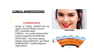 CLINICAL MANIFESTATIONS:
4.CHRONIC PACG
• Similar to POAG, EXCEPT that the
angle in Chronic PACG is narrow
• IOP - constantly raised
• EYEBALL - it is usually remains white
(without congestion) & PAINLESS
• OPTIC DISC - may show cupping
• VISUAL FIELD DEFECTS - like POAG
• GONIOSCOPY - variable degree of
angle closure
PAINLESSEYEBALL
 