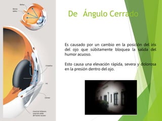 glaucoma (1) (1).pptx