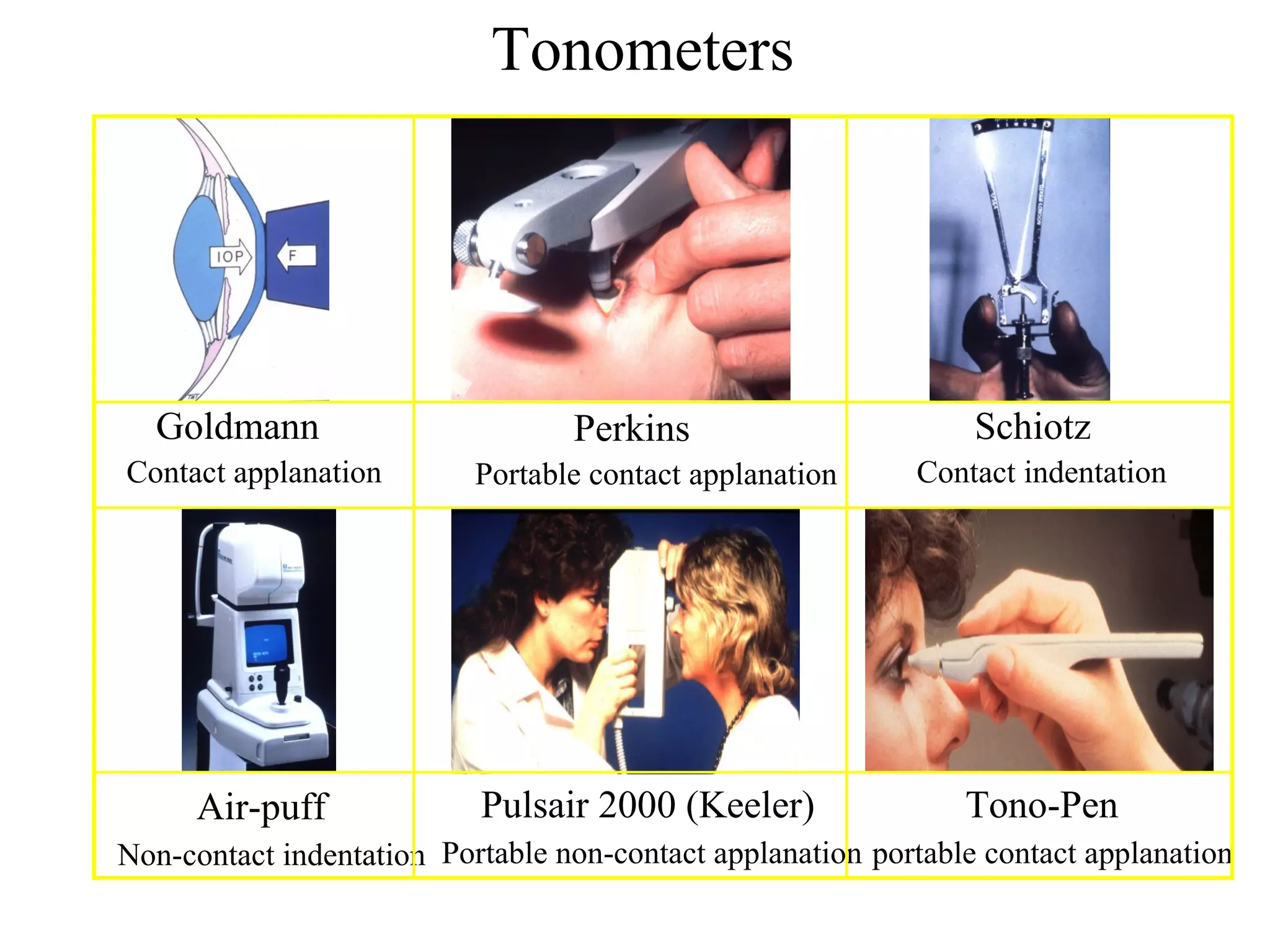 Tonometers
Goldmann
Contact applanation
Perkins
Portable contact applanation
Pulsair 2000 (Keeler)Air-puff
Schiotz
Portable non-contact applanationNon-contact indentation
Contact indentation
Tono-Pen
portable contact applanation
 