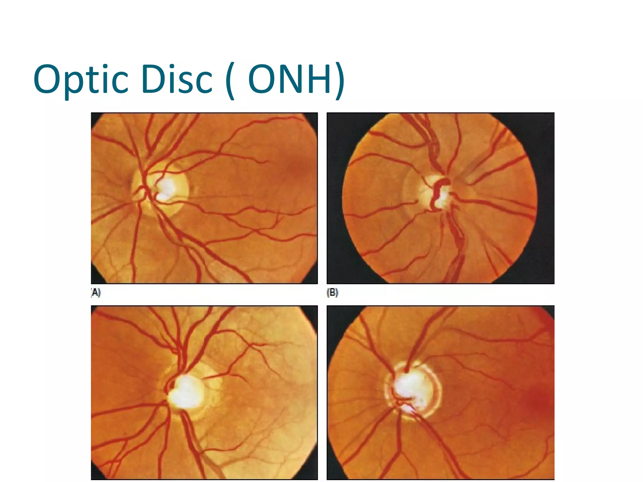 Optic Disc ( ONH)
 