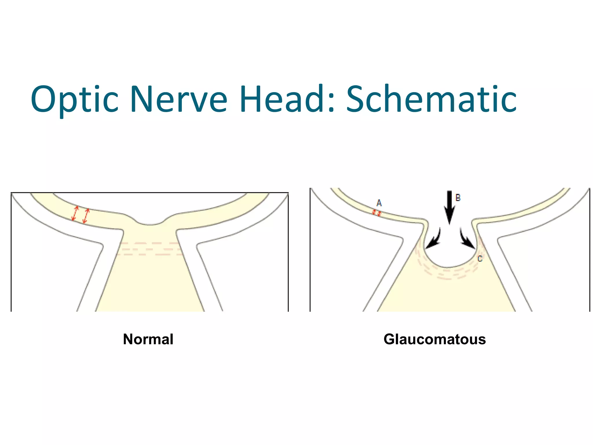 Optic Nerve Head: Schematic
Normal Glaucomatous
 