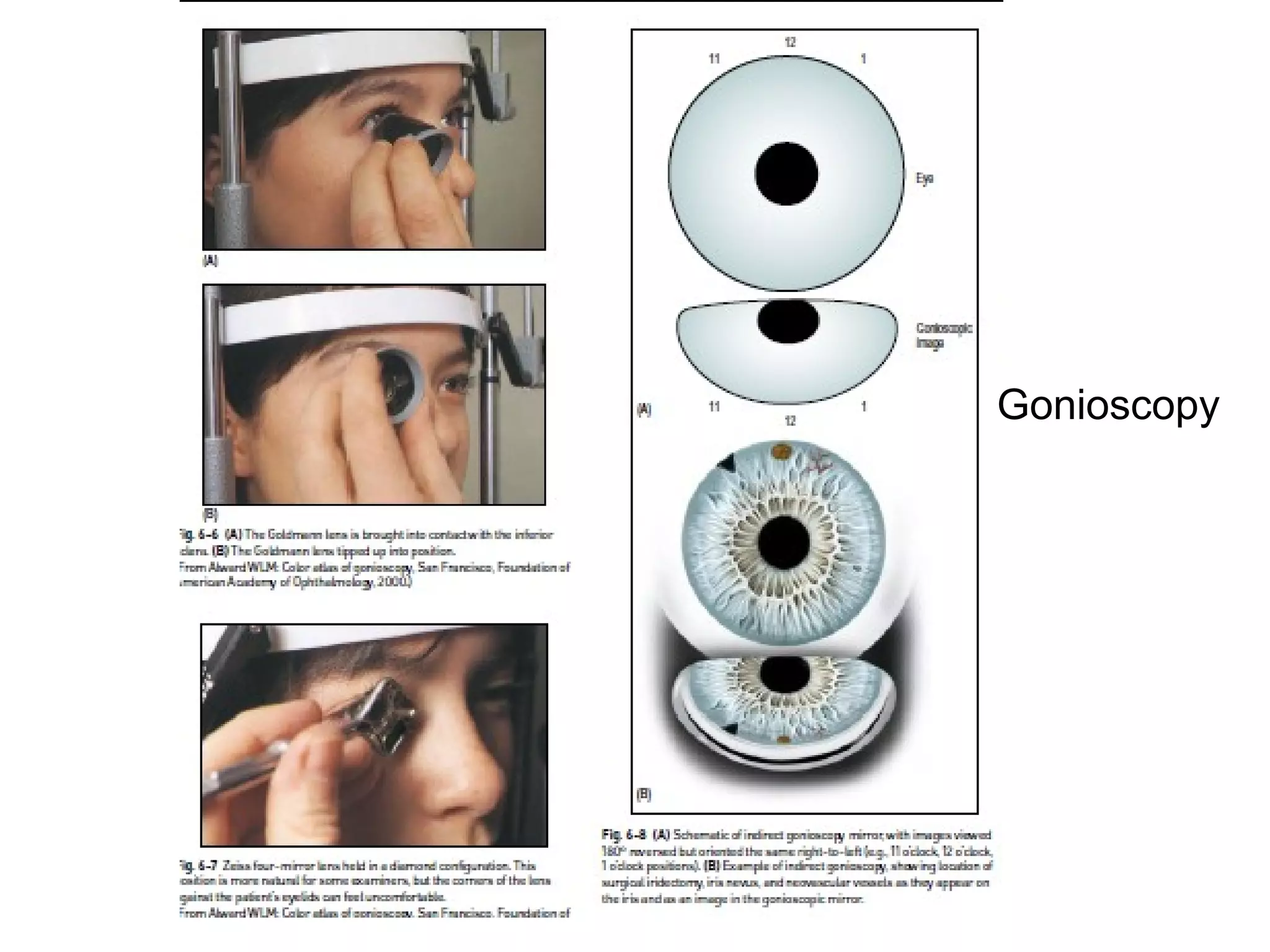 Gonioscopy
 