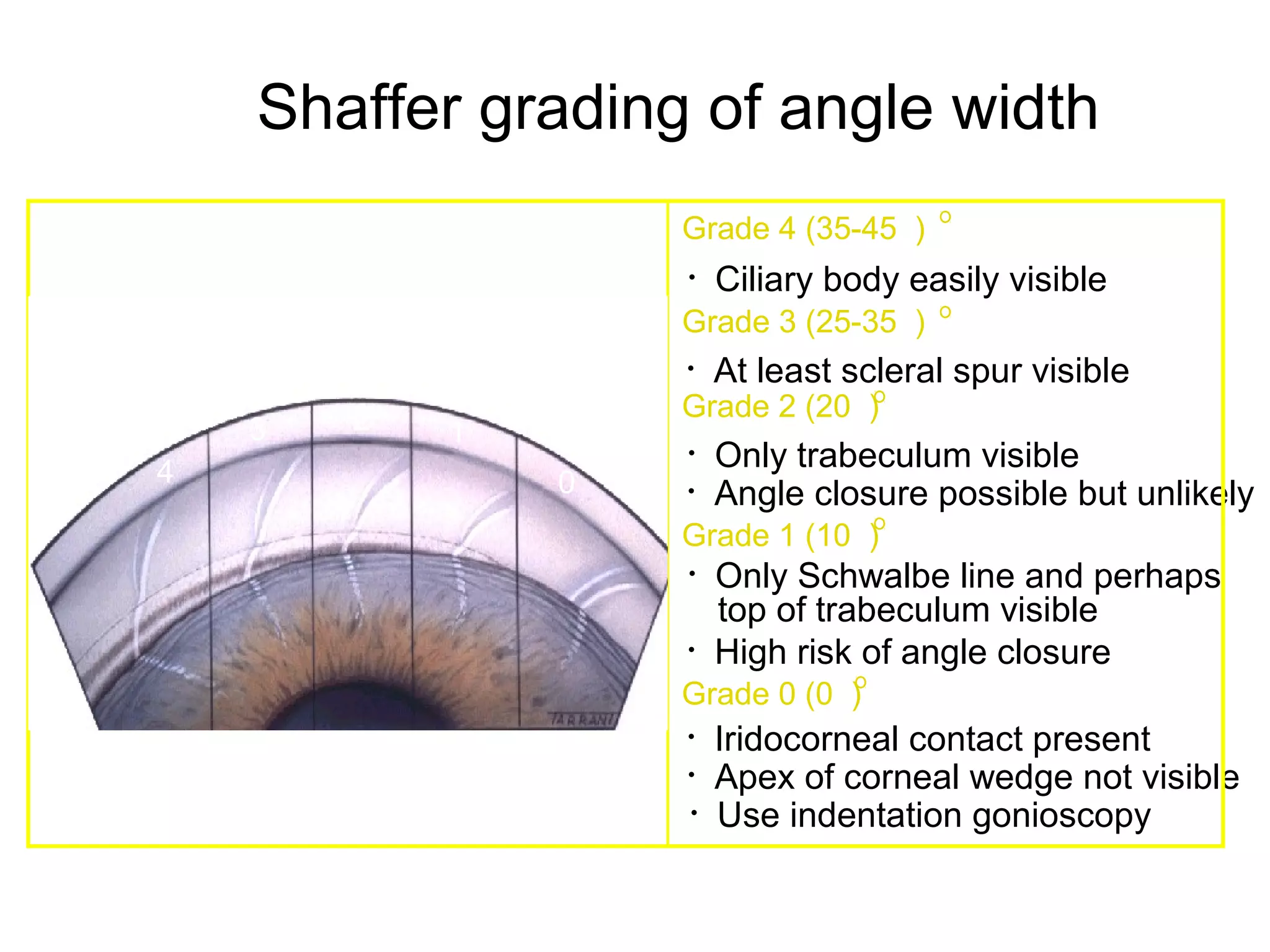 Shaffer grading of angle width
• Ciliary body easily visible
Grade 4 (35-45 )
• At least scleral spur visible
Grade 2 (20 )
Grade 3 (25-35 )
Grade 1 (10 )
• Only trabeculum visible
• Only Schwalbe line and perhaps
top of trabeculum visible
• High risk of angle closure
• Iridocorneal contact present
• Apex of corneal wedge not visible
• Angle closure possible but unlikely
• Use indentation gonioscopy
3 2 1
04
Grade 0 (0 )
 