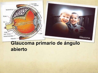 Glaucoma primario de ángulo
abierto
 