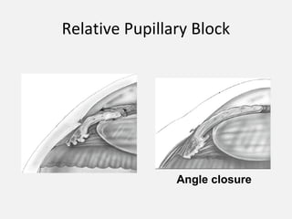 Relative Pupillary Block
Angle closure
 