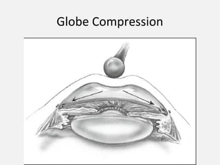 Globe Compression
 