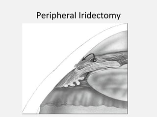 Peripheral Iridectomy
 