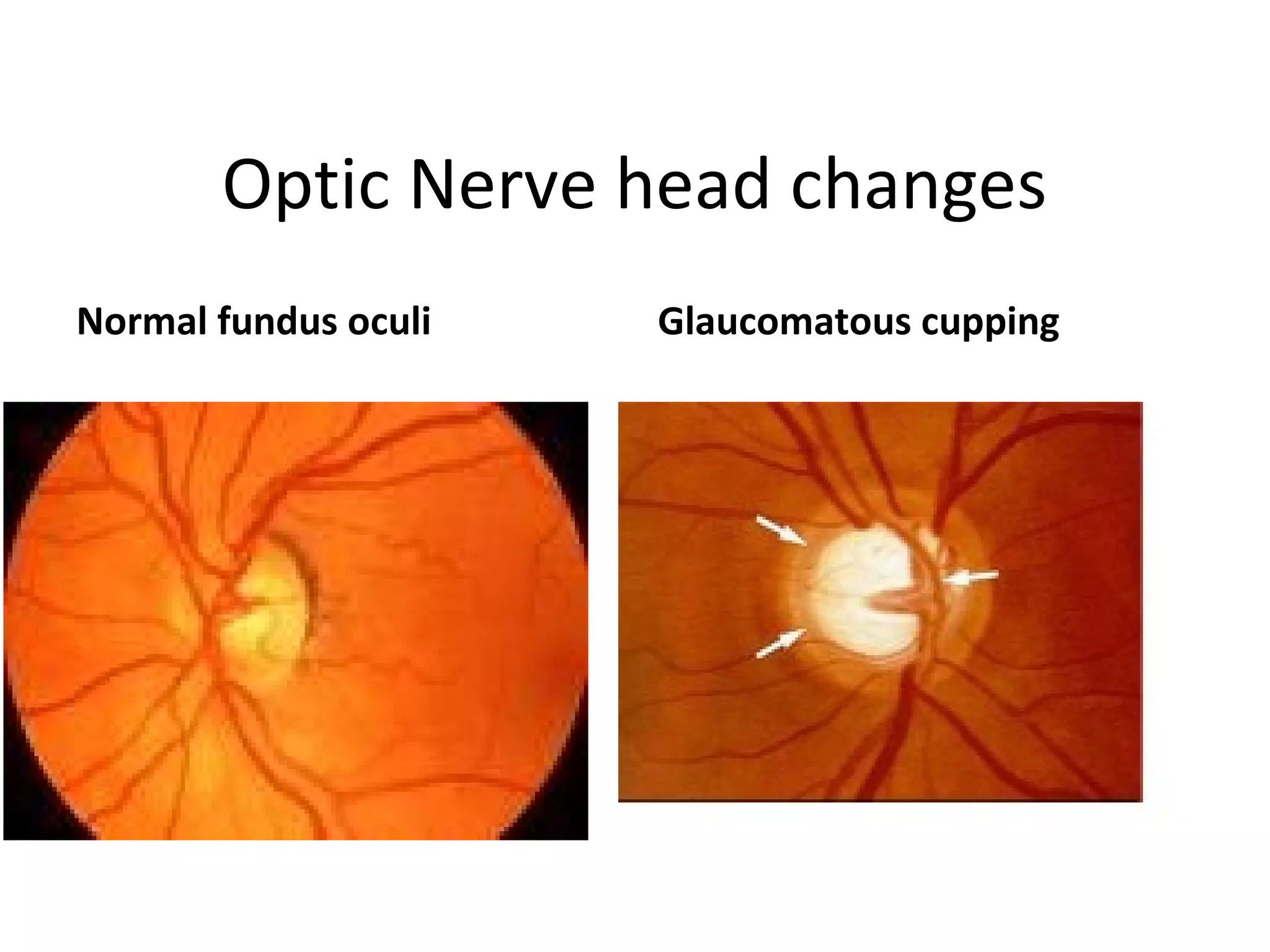 Optic Nerve head changes
Normal fundus oculi Glaucomatous cupping
 