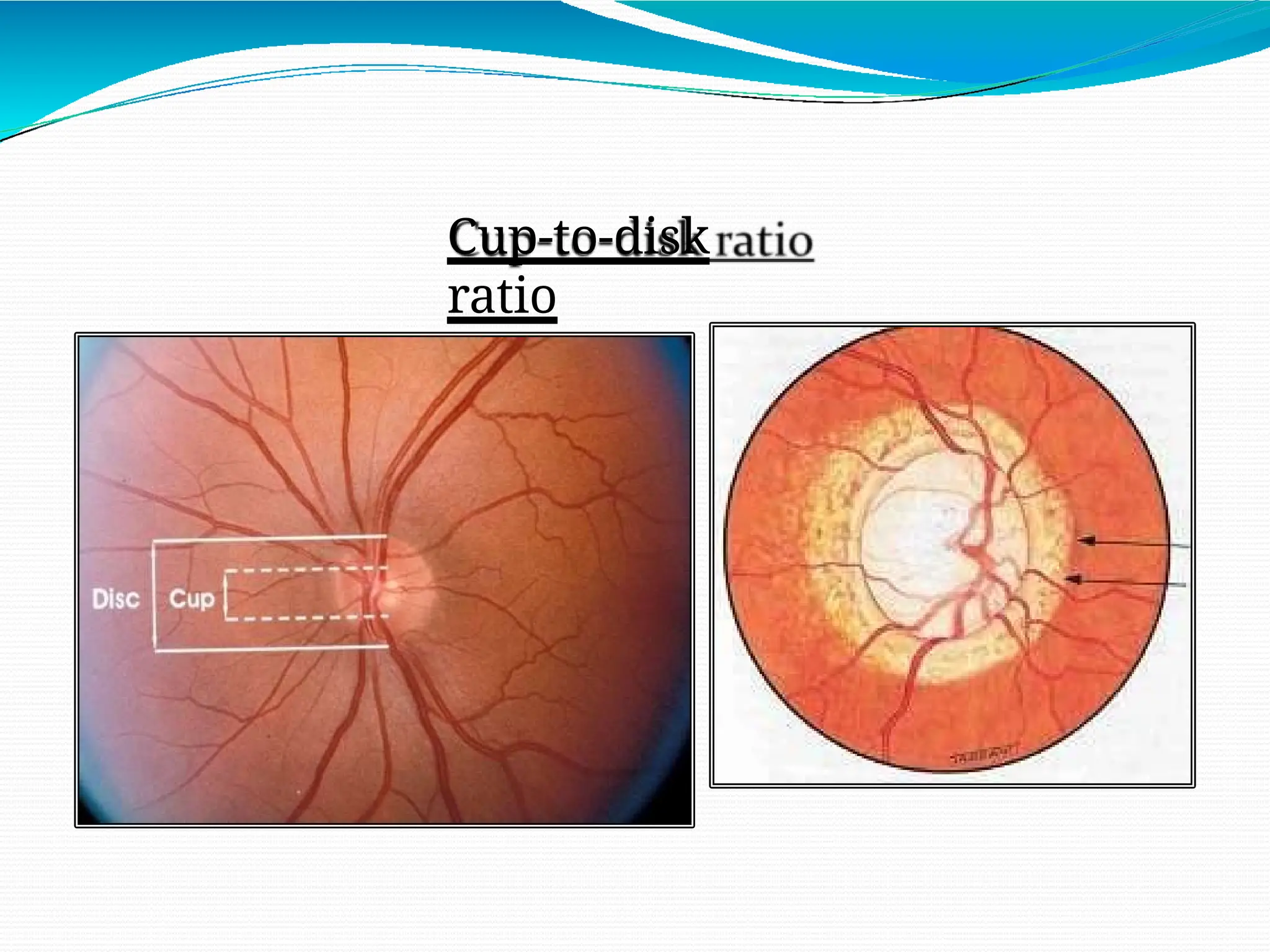 glaucoma4 human eye ,disease eye first.pptx