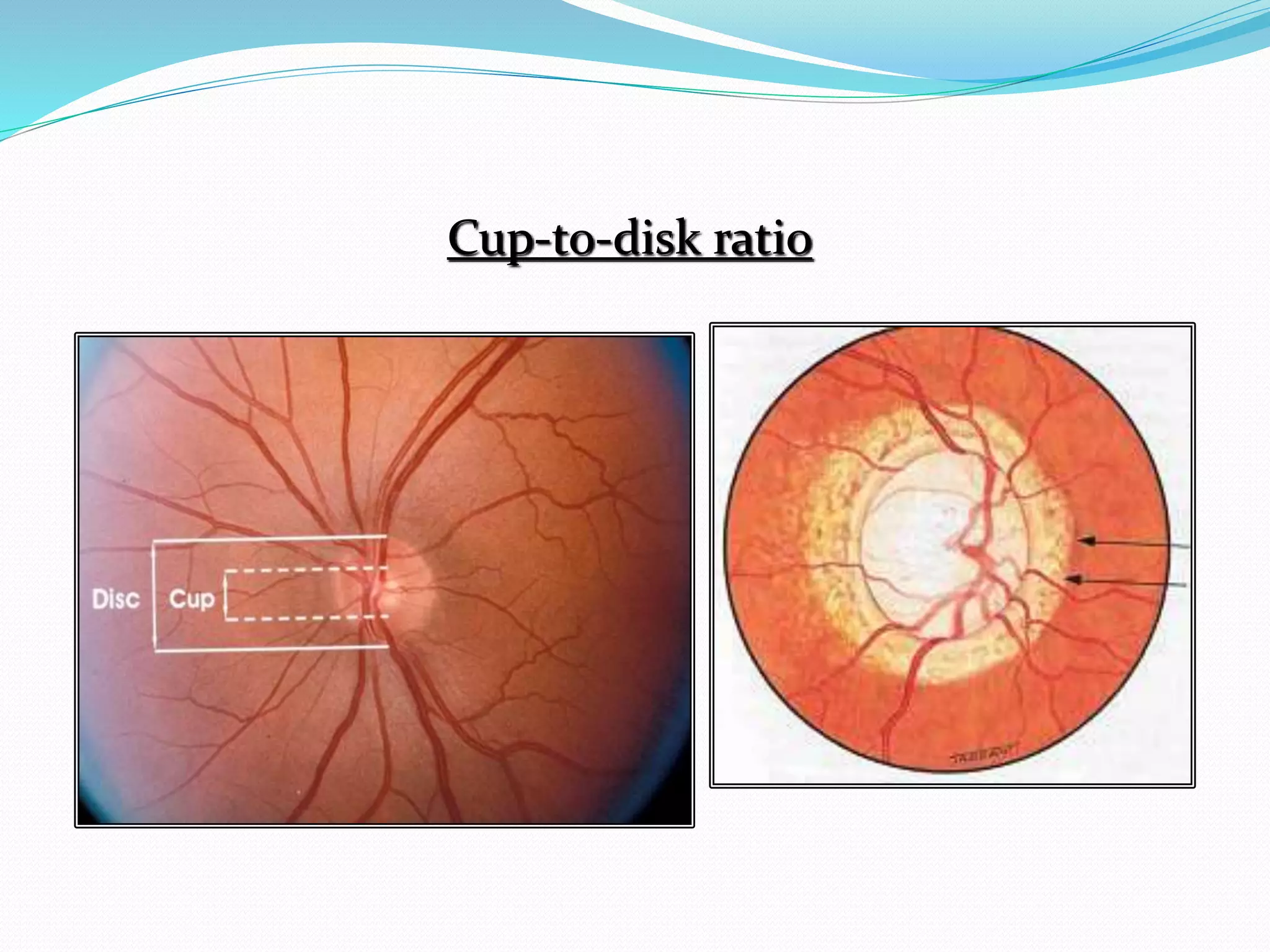 Cup/disc Ratoi Glaucoma | PPTX