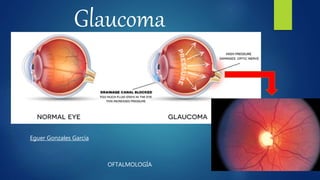 Glaucoma
OFTALMOLOGÍA
Eguer Gonzales García
 