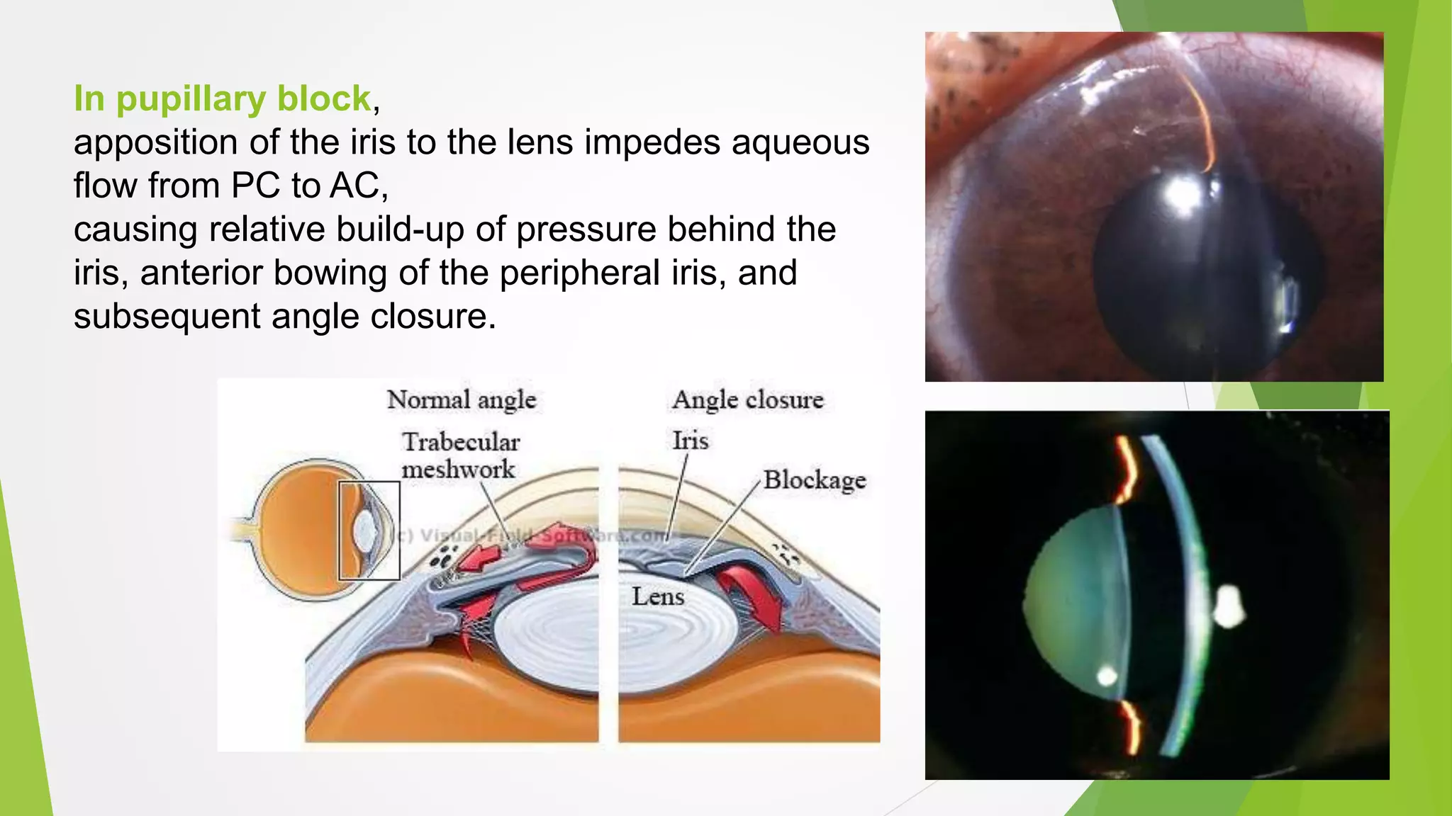 In pupillary block,
apposition of the iris to the lens impedes aqueous
flow from PC to AC,
causing relative build-up of pressure behind the
iris, anterior bowing of the peripheral iris, and
subsequent angle closure.
 