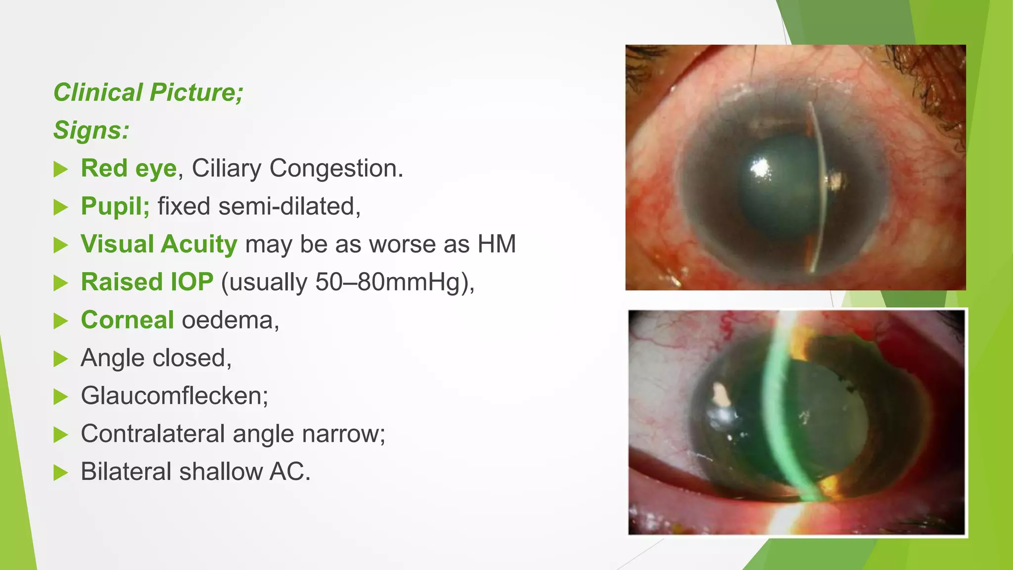 Clinical Picture;
Signs:
 Red eye, Ciliary Congestion.
 Pupil; fixed semi-dilated,
 Visual Acuity may be as worse as HM
 Raised IOP (usually 50–80mmHg),
 Corneal oedema,
 Angle closed,
 Glaucomflecken;
 Contralateral angle narrow;
 Bilateral shallow AC.
 
