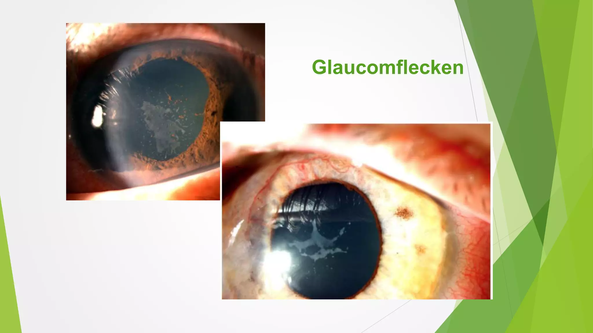 Glaucomflecken
 