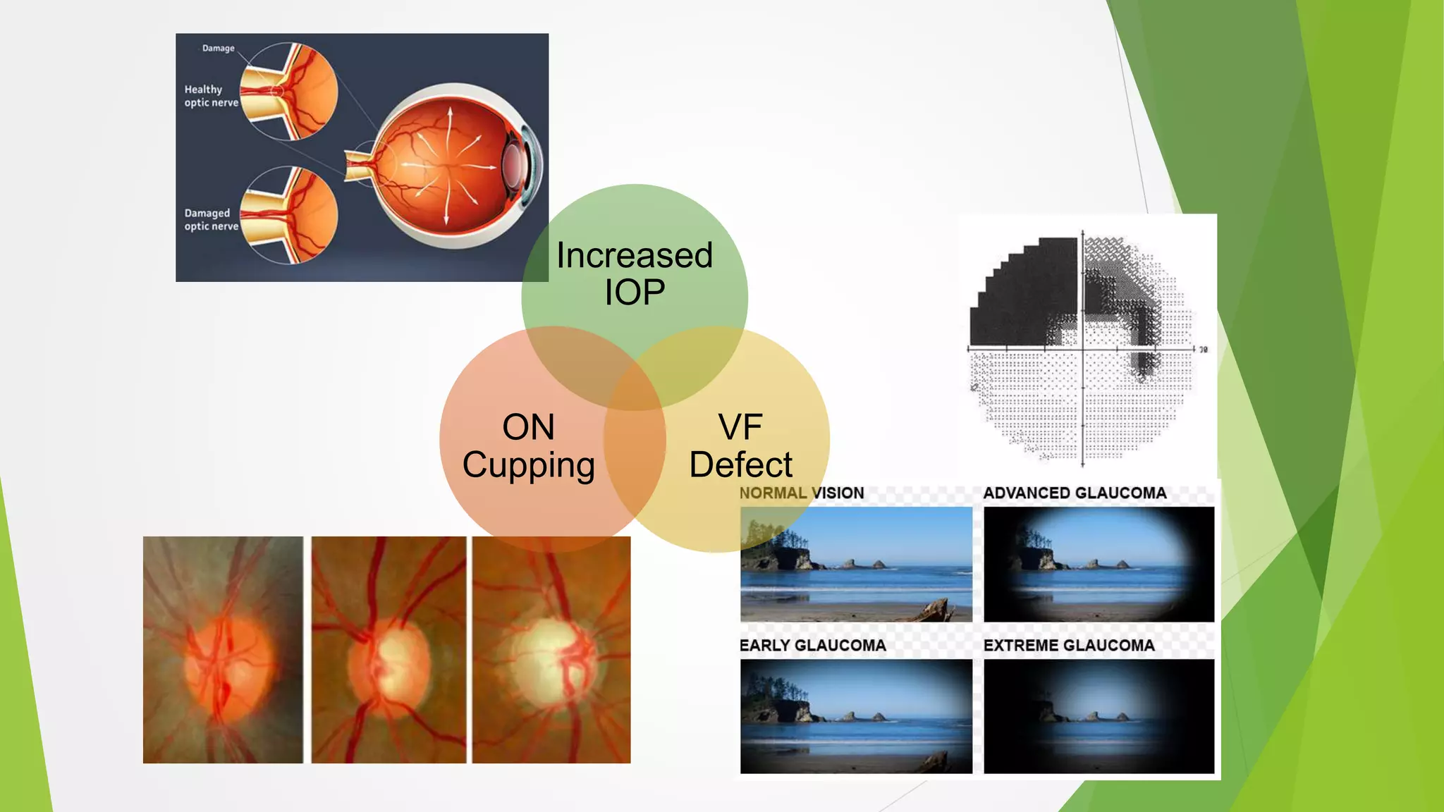 Increased
IOP
VF
Defect
ON
Cupping
 