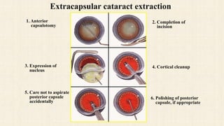 Glaucoma and cataract include treatment | PPTX