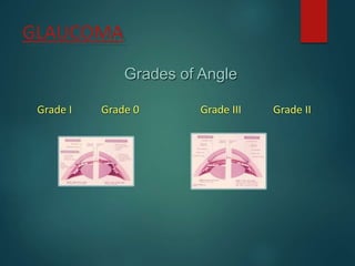GLAUCOMA
Grades of Angle
Grade I Grade 0 Grade III Grade II
 