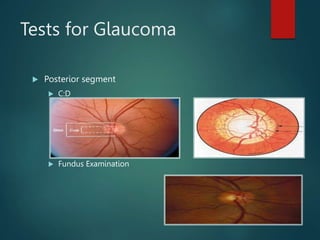 Tests for Glaucoma
 Posterior segment
 C:D
 Fundus Examination
 