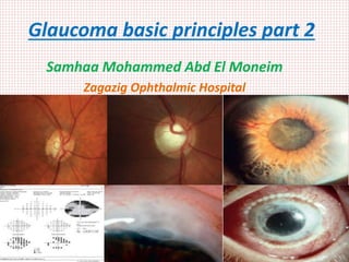Glaucoma basic principles part 2
Samhaa Mohammed Abd El Moneim
Zagazig Ophthalmic Hospital
 