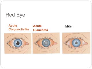 Red Eye
Acute
Conjunctivitis
Acute
Glaucoma
Iritis
 