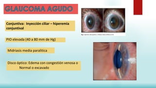 Conjuntiva: Inyección ciliar – hiperemia
conjuntival
PIO elevada (40 a 80 mm de Hg)
Midriasis media paralitica
Disco óptico: Edema con congestión venosa o
Normal o excavado
 