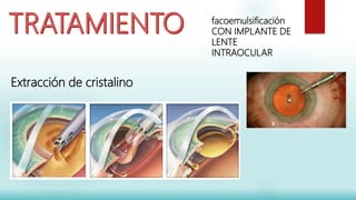 Extracción de cristalino:
facoemulsificación
CON IMPLANTE DE
LENTE
INTRAOCULARn
 