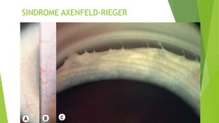 Glaucoma CONGENITO.pptx