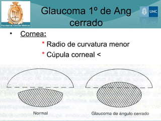 Glaucoma 1º de Ang
               cerrado
•   Cornea:
         * Radio de curvatura menor
         * Cúpula corneal <
 