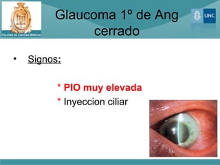 Glaucoma 1º de Ang
               cerrado
•   Signos:

          * PIO muy elevada
          * Inyeccion ciliar
 