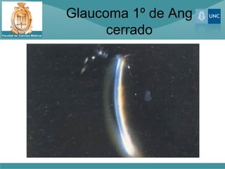 Glaucoma 1º de Ang
      cerrado
 