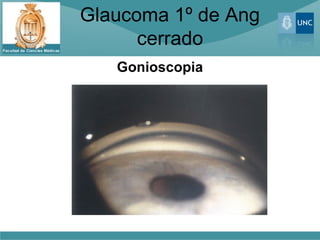 Glaucoma 1º de Ang
      cerrado
   Gonioscopia
 