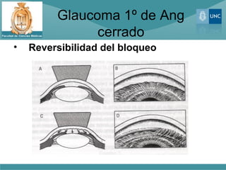 Glaucoma 1º de Ang
               cerrado
•   Reversibilidad del bloqueo
 