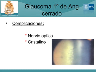 Glaucoma 1º de Ang
               cerrado
•   Complicaciones:

          * Nervio optico
          * Cristalino
 