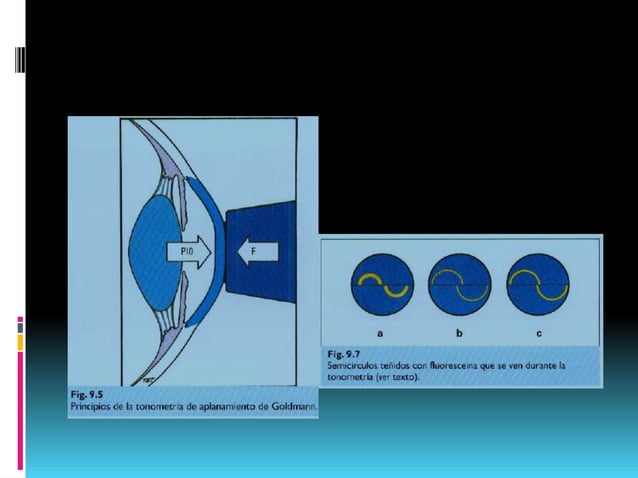 Glaucoma de angulo cerrado by dr glen hernandez | PPT