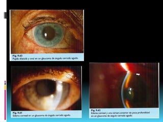 Glaucoma de angulo cerrado by dr glen hernandez | PPTX