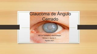 Glaucoma de ángulo cerrado | PPTX