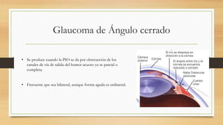 Glaucoma de ángulo cerrado | PPTX