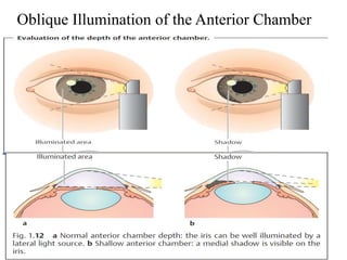Oblique Illumination of the Anterior Chamber
 