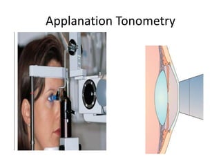 Applanation Tonometry
 