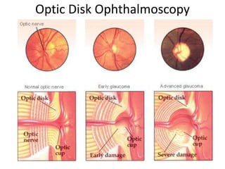Optic Disk Ophthalmoscopy
 