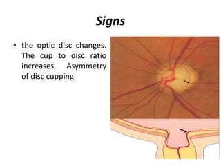 Signs
• the optic disc changes.
The cup to disc ratio
increases. Asymmetry
of disc cupping
 