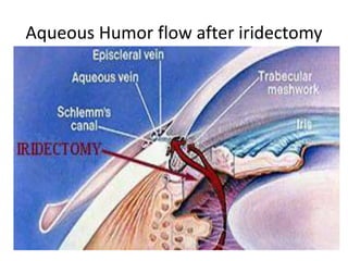 Aqueous Humor flow after iridectomy
 